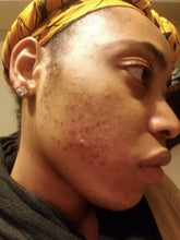 Load image into Gallery viewer, Kojic Discoloration Bar Soap